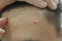 Bố mẹ tá hỏa khi biết con cấp một bị sùi mào gà: Bất ngờ với nguồn lây