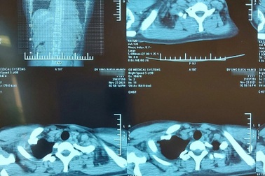 Cô gái 19 tuổi ở Hà Nội bị khối u quái to 20cm đè bẹp phổi