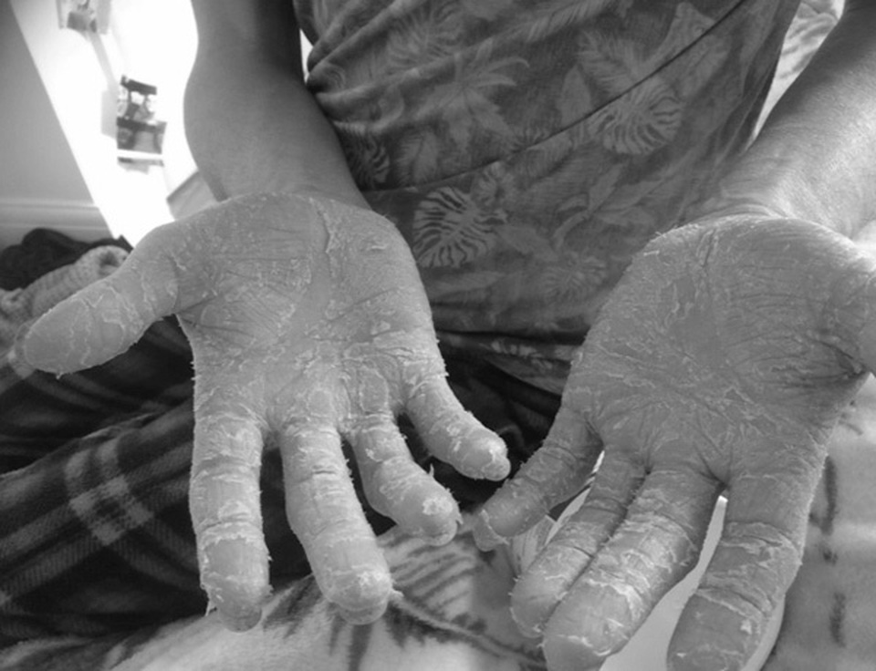 Phát hiện mắc ung thư từ nốt phát ban nhỏ ở thắt lưng - 2