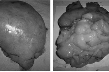 Cắt khối u mỡ hiếm gặp nặng 1,5kg 