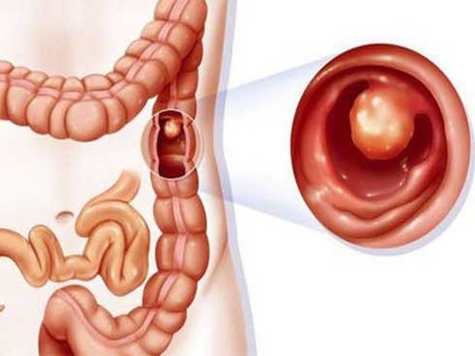 Bệnh nhân ung thư đại trực tràng sống được bao lâu? - 1 Bệnh nhân ung thư đại trực tràng sống được bao lâu? - 1