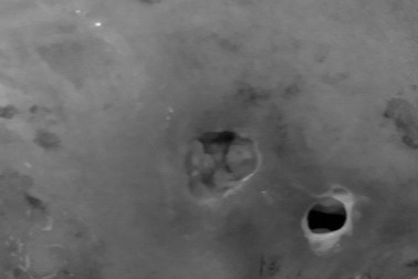 Sốc với hình ảnh thủng da, chảy mủ vì đắp lá chữa mụn nhọt