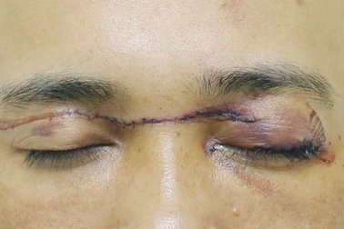 Người đàn ông bị dây thả diều "cứa" rách mi mắt