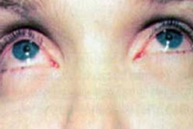 Xử trí với bệnh đau mắt đỏ