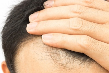 Bạn sẽ bị hói? Gen của bạn sẽ trả lời điều đó