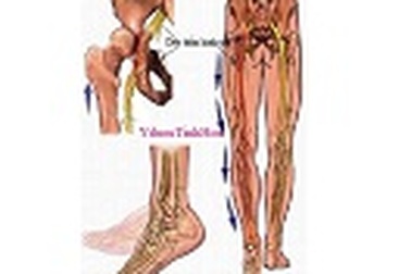 Thần kinh tọa và thoát vị đĩa đệm