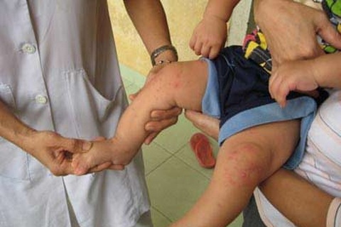 Hà Nội: Bệnh nhi tử vong do bị tay chân miệng thể tối cấp