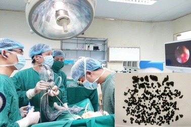 Lấy gần 1.000 viên sỏi đường mật trong gan bệnh nhân