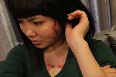 Cô gái bị xăm "quái vật" vào mặt và ngực mang thương tật 30%