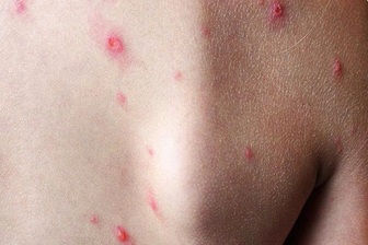 Một tỉnh phía Nam ghi nhận ca mắc đậu mùa khỉ đầu tiên