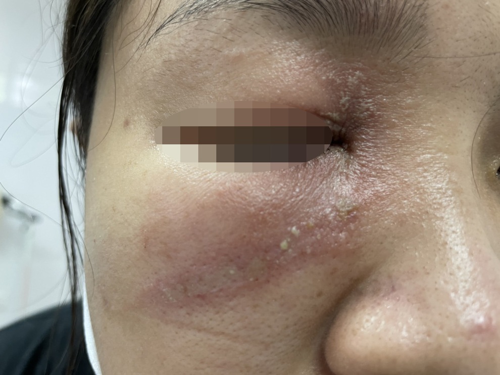 Sưng húp mắt, bỏng rộp, vằn vện khắp người sau một đêm vì kiến ba khoang - 3 Sưng húp mắt, bỏng rộp, vằn vện khắp người sau một đêm vì kiến ba khoang - 3