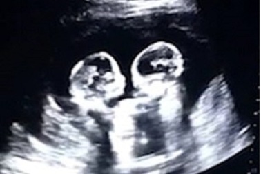 Thú vị hình ảnh chị em song sinh đánh nhau từ trong bụng mẹ