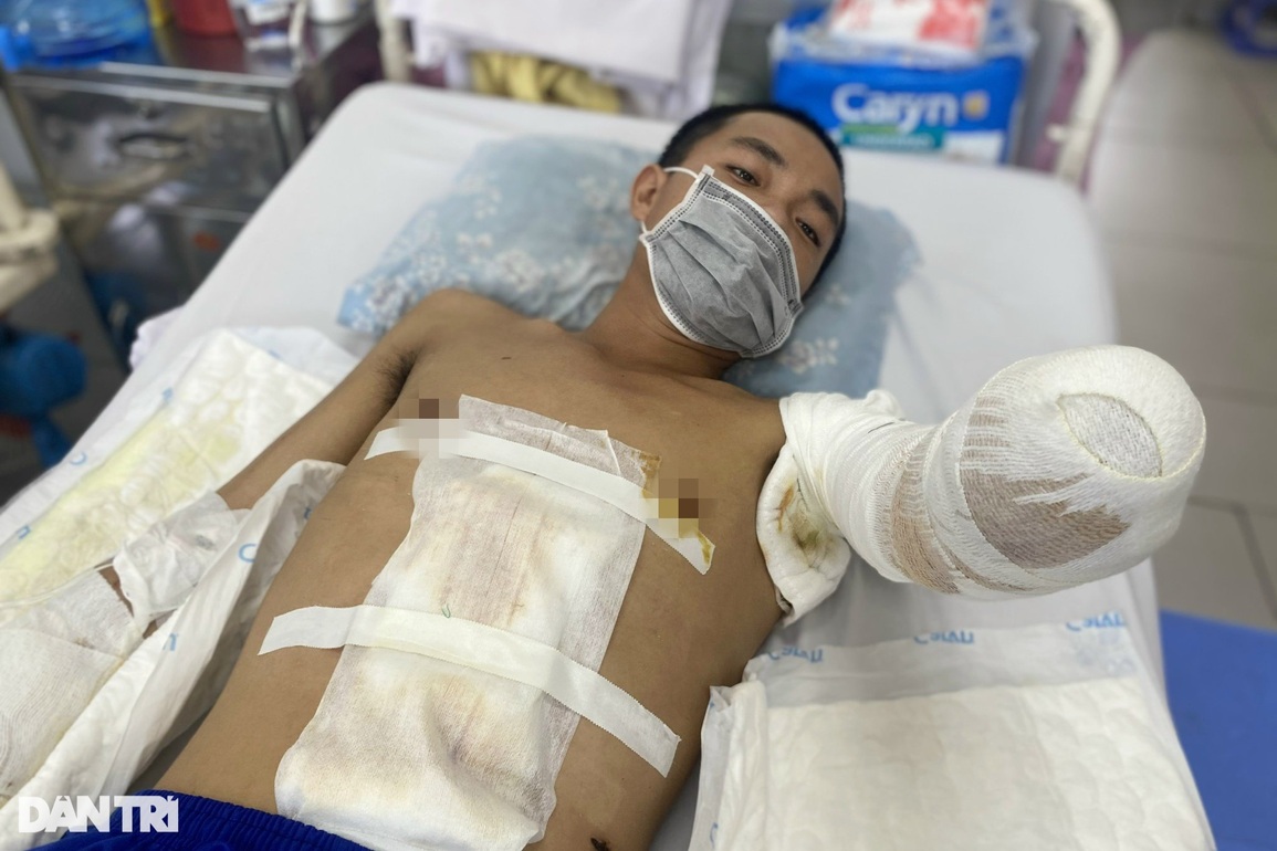 Gia tăng bỏng điện: Nhiều người bị cắt cụt tay, chân - 3 Gia tăng bỏng điện: Nhiều người bị cắt cụt tay, chân - 3