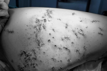 Bé trai 11 tuổi nhập viện với chi chít vết thương do pháo nổ