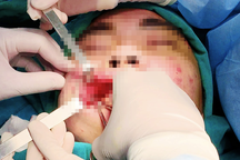 Mỗi năm, Việt Nam xảy ra 35.000 ca biến chứng thẩm mỹ