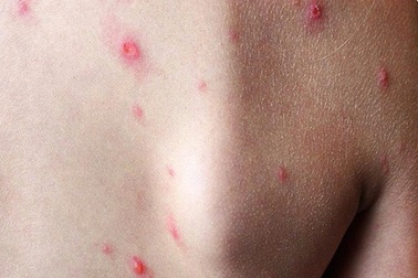 Một tỉnh phía Nam ghi nhận ca mắc đậu mùa khỉ đầu tiên