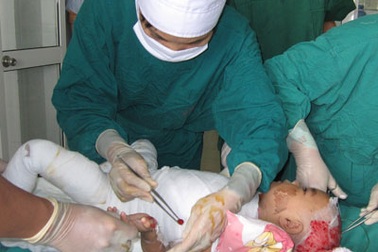 Nhiều trẻ nhỏ bị bỏng sâu vì không được cởi ngay quần áo ngấm nước nóng