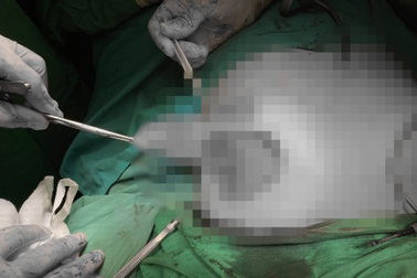 Nghe lời thẩm mỹ viện "nặn mủ" ngực vừa nâng, cô gái bị biến chứng nặng nề