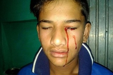 Mắc bệnh lạ khiến cậu bé “khóc” ra máu nhiều lần mỗi ngày