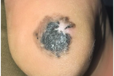 Nhận diện đốm đen bất thường cảnh báo ung thư da