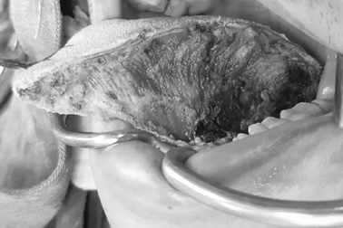 Nhiều người bỗng nhiên phải cắt lưỡi vì ung thư