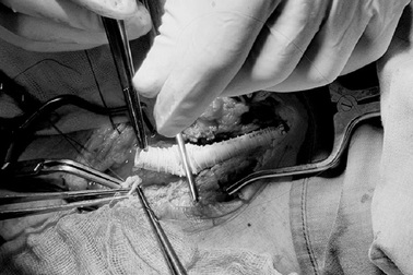 Máu phun thành vòi vì chích ma túy vào động mạch đùi