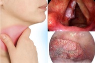 Nhận biết dấu hiệu ung thư thanh quản để không bỏ lỡ "thời gian vàng"