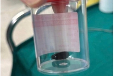 Bé trai Campuchia thoát nguy sau khi sang Việt Nam cấp cứu