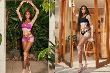 Siêu mẫu bạch biến Winnie Harlow quyến rũ trong ảnh quảng cáo mới