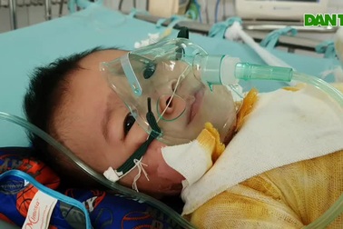 Bé 20 tháng tuổi bị bỏng nước sôi nguy kịch