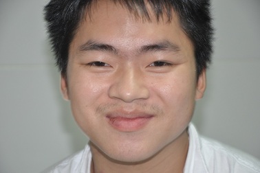 Nụ cười của chàng trai trẻ dân tộc Dao được cứu sống nhờ tấm lòng bạn đọc báo Dân trí