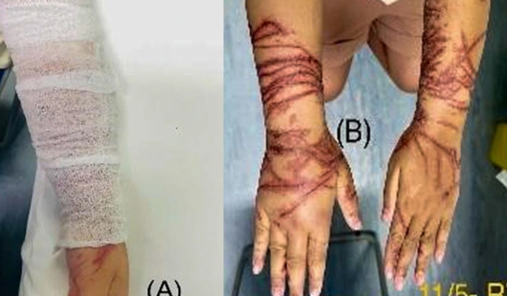 Vòng tay ôm sứa biển trong suốt, bé gái bị bỏng rát chằng chịt 2 cẳng tay - 2 Vòng tay ôm sứa biển trong suốt, bé gái bị bỏng rát chằng chịt 2 cẳng tay - 2