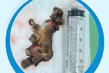 Sỏi san hô to như củ gừng nằm trong thận người đàn ông