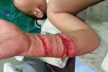 Cá sấu cắn đứt gân tay bé 4 tuổi