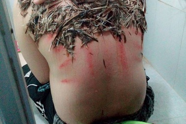 Thực hư việc trị bệnh đậu lào bằng lông và máu gà