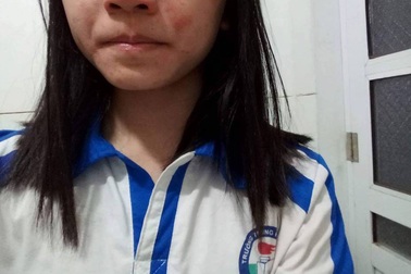 Hà Nội: Hàng loạt học sinh bỗng nhiên bị mẩn ngứa, dị ứng