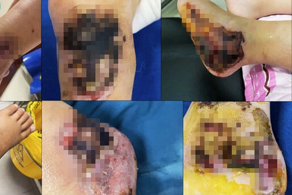 Kẹt chân vào bánh xe, chó cắn nát mặt và những hiểm họa tấn công trẻ mùa hè - 2 Kẹt chân vào bánh xe, chó cắn nát mặt và những hiểm họa tấn công trẻ mùa hè - 2