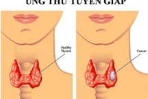 Điều trị Iod phóng xạ là gì?