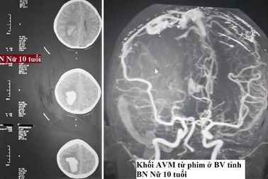 Cứu sống thần kỳ bệnh nhi 10 tuổi chảy máu não