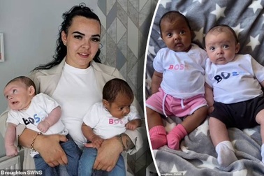 Lạ lùng cặp song sinh cùng cha, cùng mẹ nhưng khác... màu da