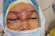Mẹ bơm xe bị nổ lốp, mảnh vỡ bắn thẳng vào hỏng mắt con trai