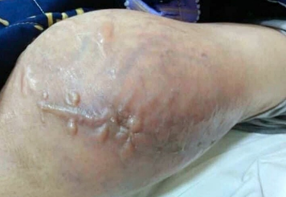 Chàng trai 18 tuổi bất ngờ phát hiện ung thư xương sau một lần đi đá bóng - 1 Chàng trai 18 tuổi bất ngờ phát hiện ung thư xương sau một lần đi đá bóng - 1