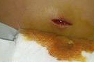 Người phụ nữ bị đạn găm vào lưng khi đang ngồi chơi