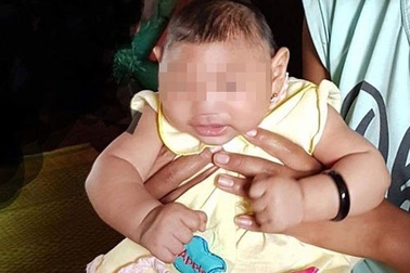 Việt Nam xác nhận ca mắc hội chứng đầu nhỏ do vi rút Zika đầu tiên