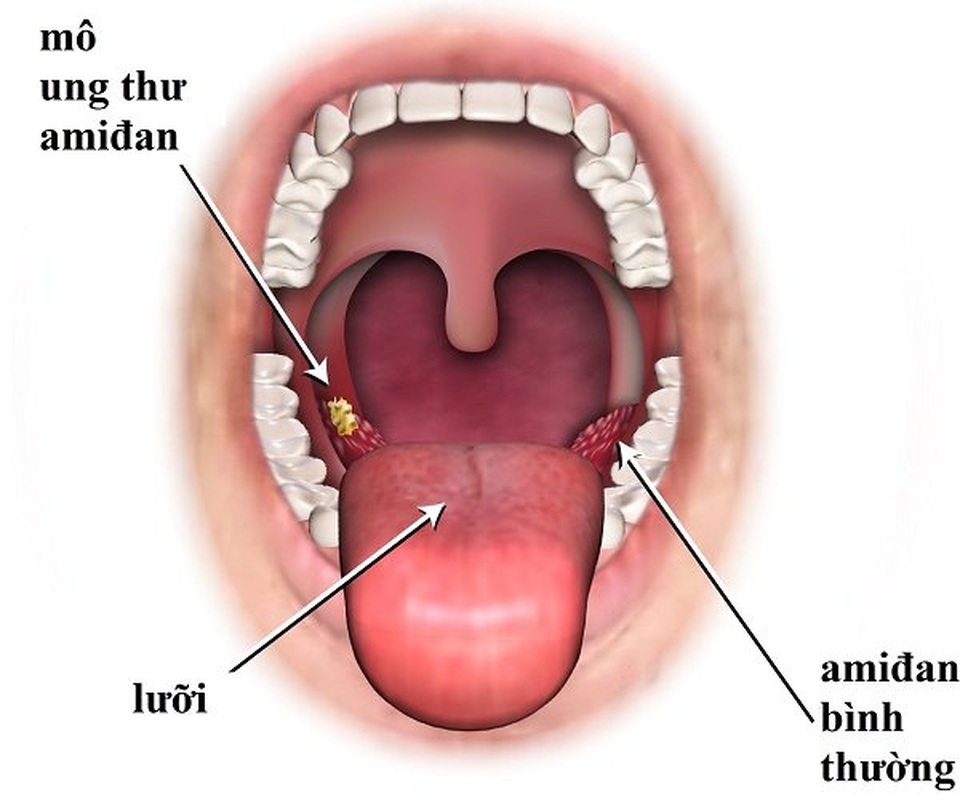 Dấu hiệu nhận biết ung thư amidan - 1 Dấu hiệu nhận biết ung thư amidan - 1