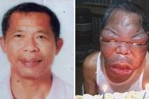 Người đàn ông nghèo mắc bệnh lạ khiến mặt sưng phồng to gấp 3, 4 lần