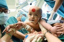 Cuộc đại phẫu "cân não" tách cặp song sinh dính nhau phức tạp đã thành công