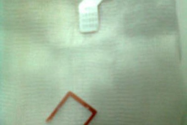 Khung sim điện thoại nằm vắt ngang thực quản bé 2 tuổi