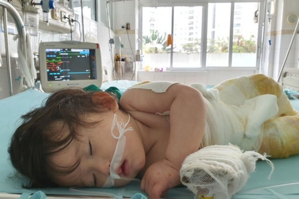 Bé gái 14 tháng tuổi ngã vào nồi nước sôi được bạn đọc giúp đỡ đã xuất viện - 2 Bé gái 14 tháng tuổi ngã vào nồi nước sôi được bạn đọc giúp đỡ đã xuất viện - 2