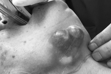 Nhận biết ung thư tuyến nước bọt giai đoạn sớm